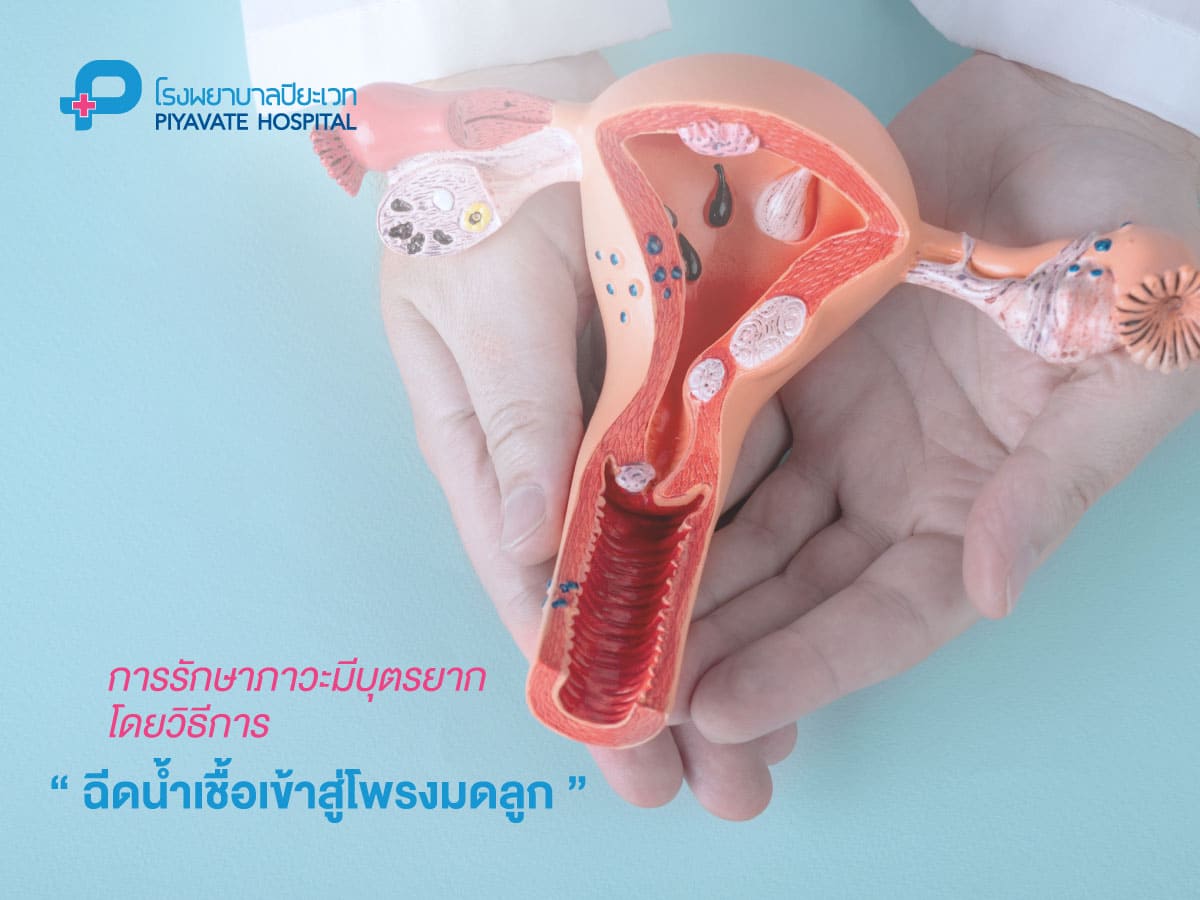 การรักษาภาวะผู้มีบุตรยากโดยการฉีดน้ำเชื้อเข้าสู่โพรงมดลูก