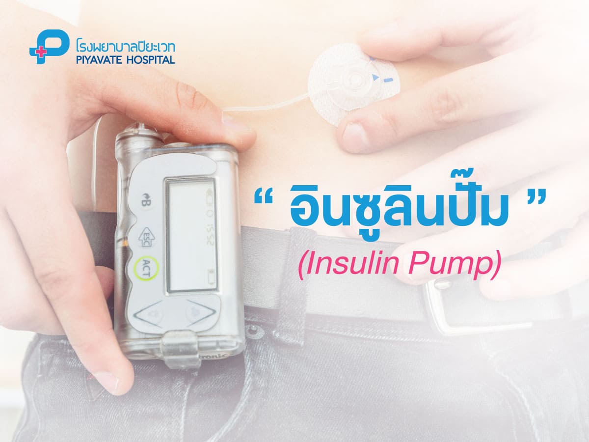 อินซูลินปั๊ม (Insulin Pump)