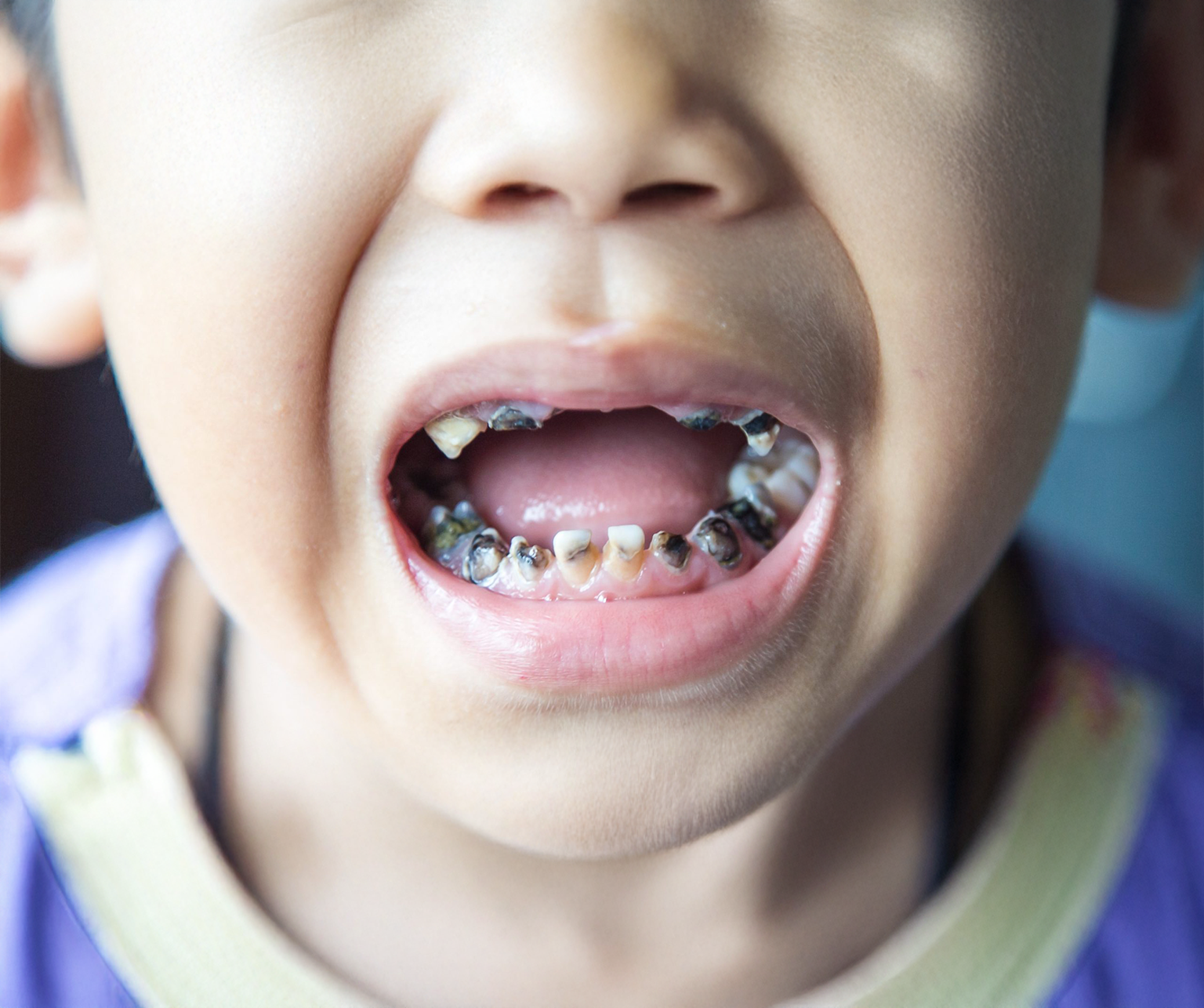 What to do if your child has a decayed baby tooth?