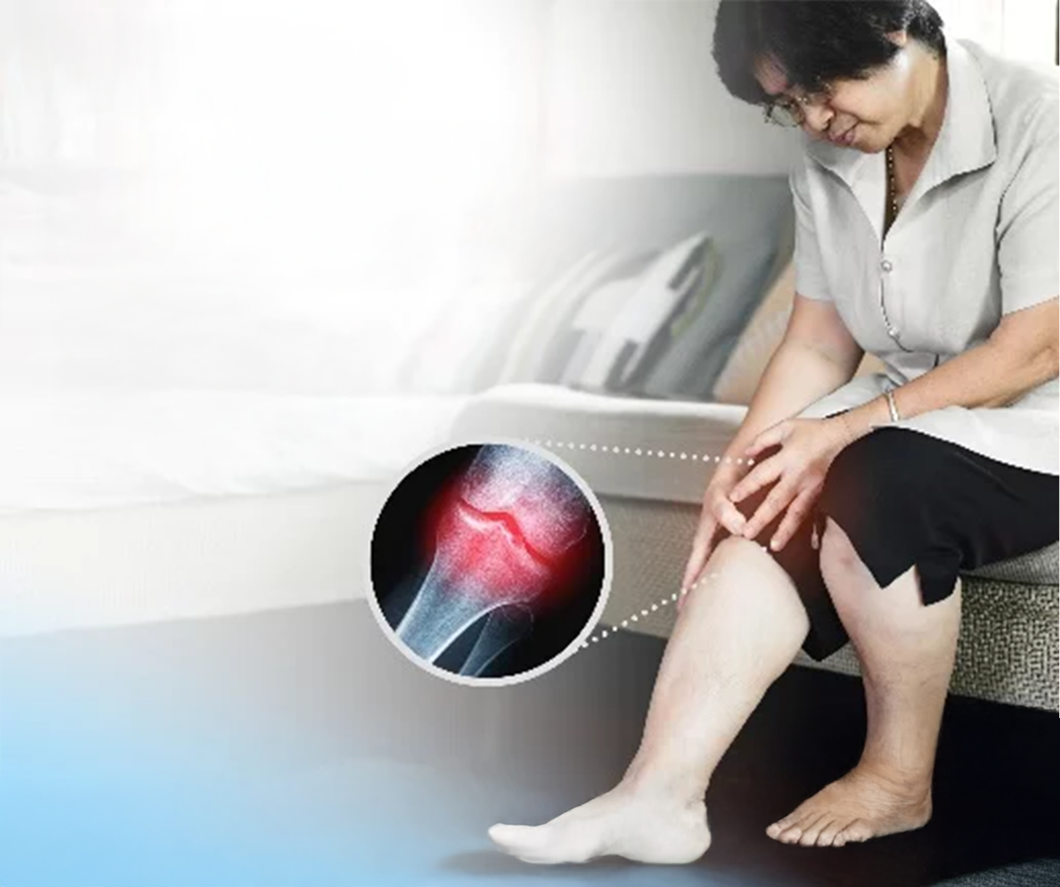 Chinese Medicine : Osteoarthritis of the Knee (KOA) 膝关节骨关节炎