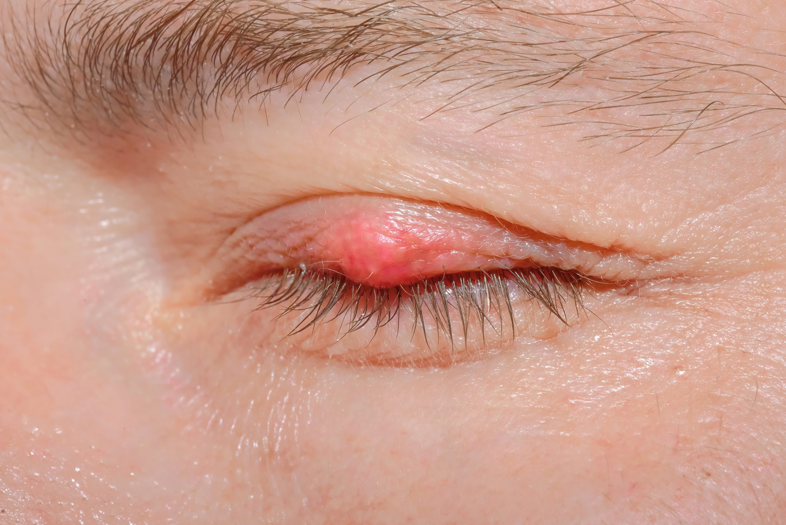 ต่อมไขมันที่เปลือกตาอุดตัน (Meibomian gland dysfunction, MGD)