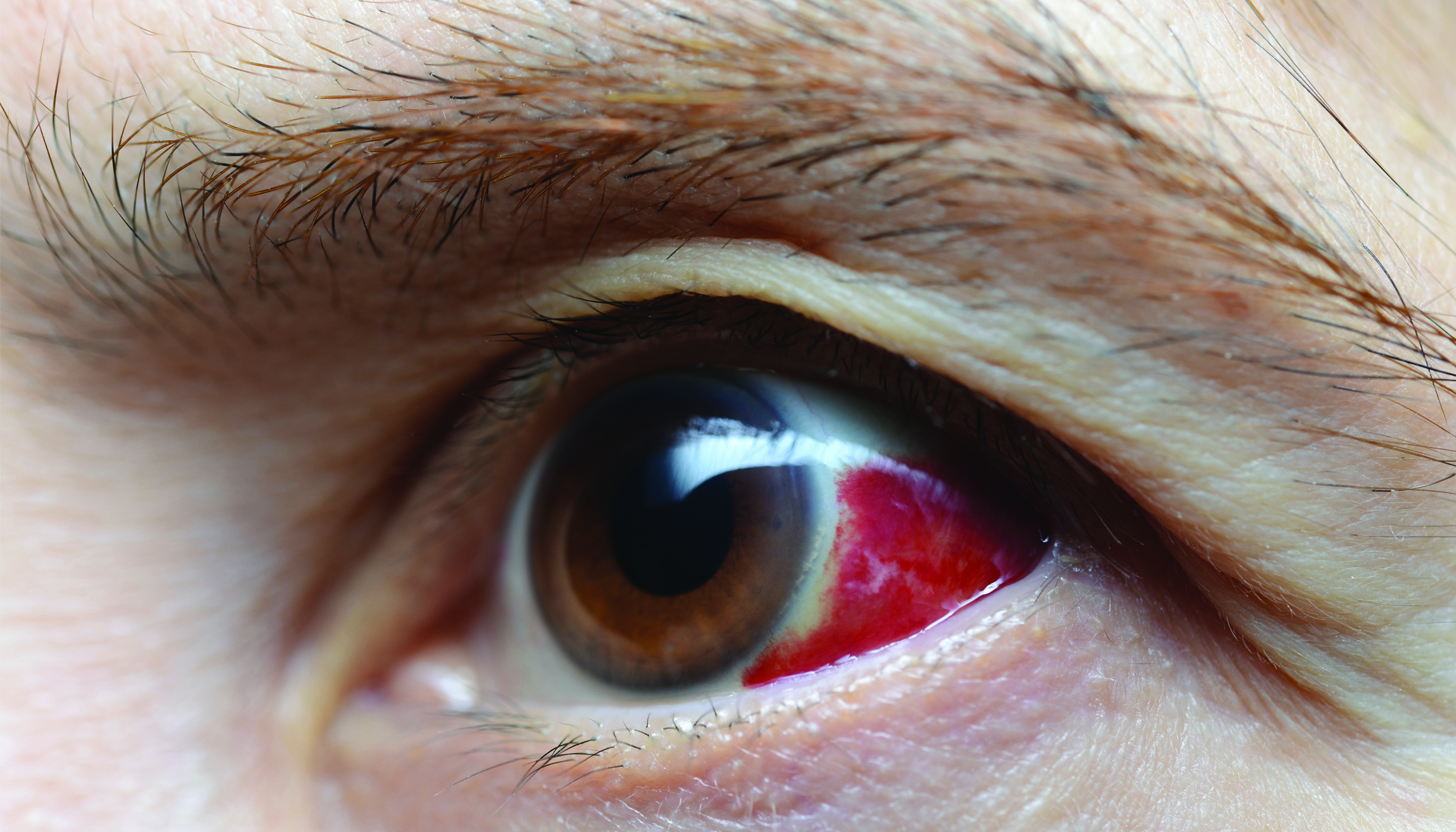 ต้อกระจก (Cataract)